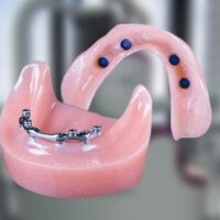 cost snap in dentures