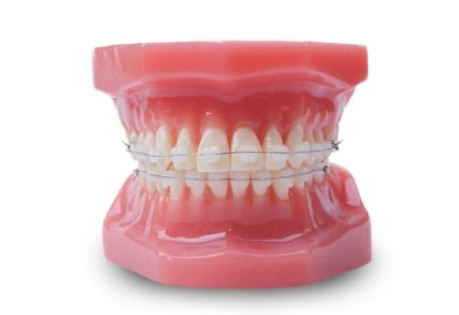Invisalign Tijuana Align Your Teeth Prices & Free Quote [2023]