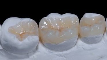 Dental Resin Fillings in Tijuana, Mexico - The Dental District