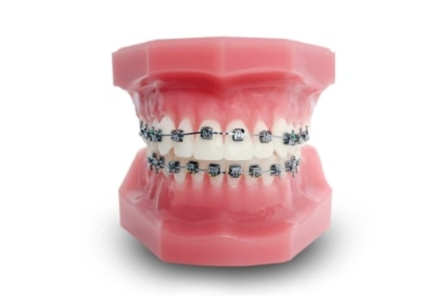 Invisalign Tijuana Align Your Teeth Prices & Free Quote [2023]