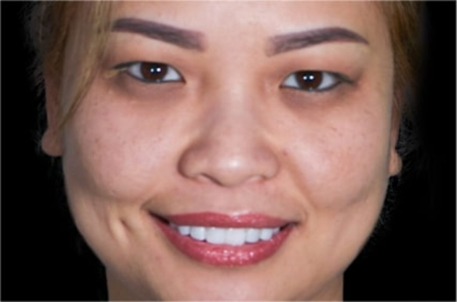 How Much Are Veneers In Tijuana? Composite Or Porcelain Prices 2023