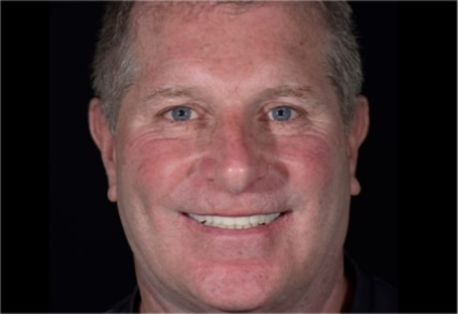 x dentistry patient implants after 02