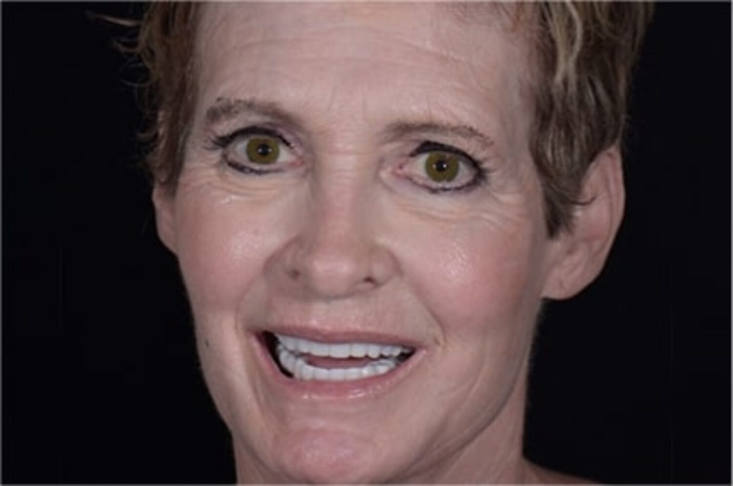 x dentistry patient implants after 03