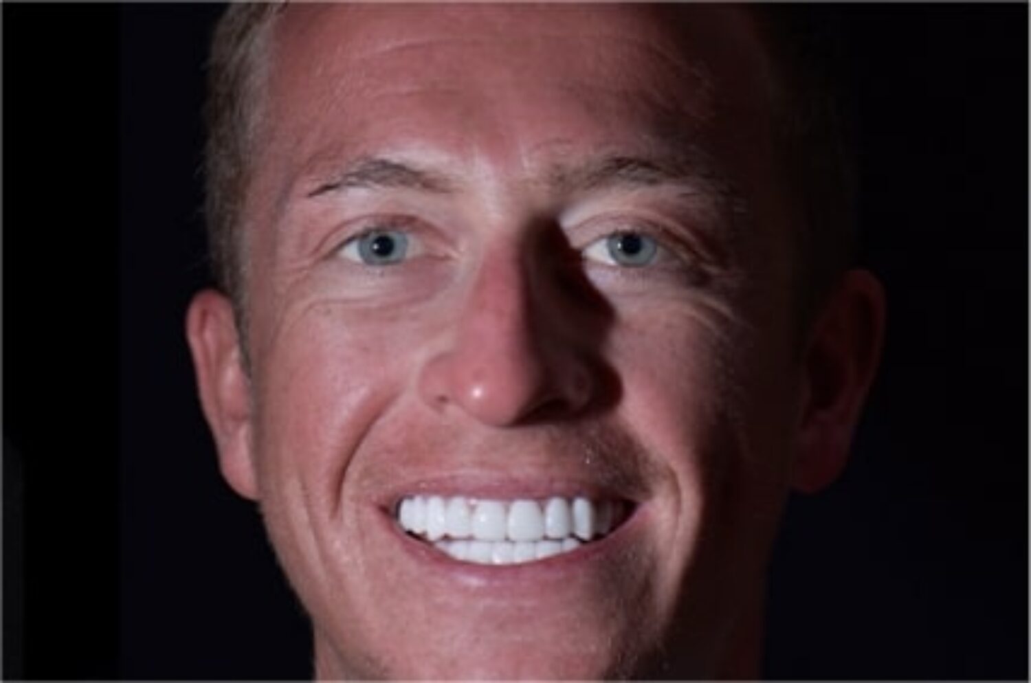 x dentistry teeth whitening patient after price 01