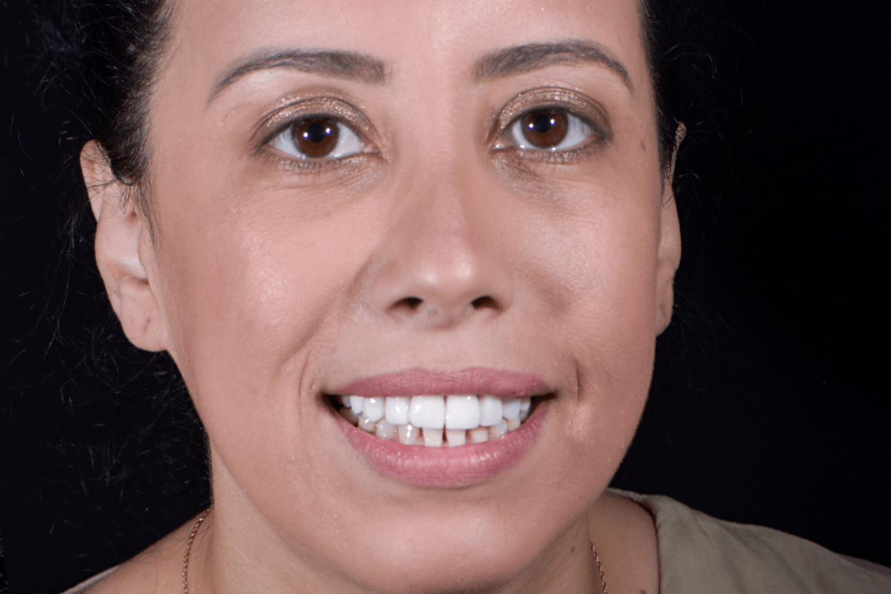How Much Are Veneers In Tijuana? Composite Or Porcelain Prices 2023