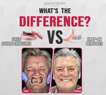 Fixed Hybrid Dentures or Snap