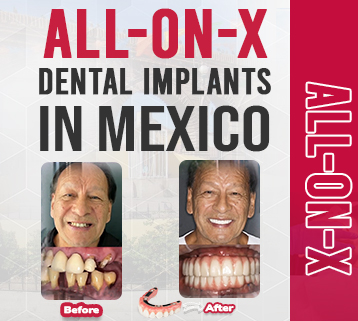 All-On-X Dental Implants in Mexico: The Guide to Affordable Full Mouth Restoration in 2026