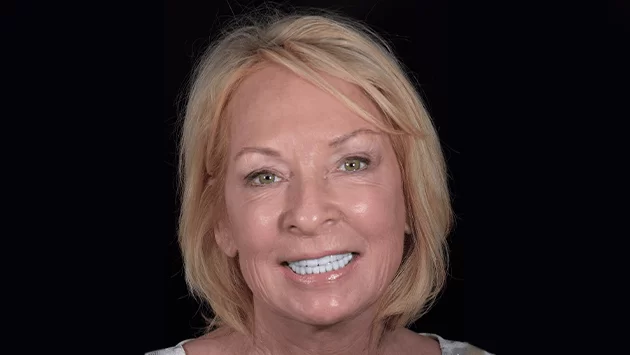 xdentistry all on 4 patient 04