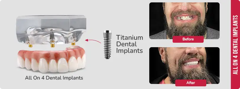 before & after titanium implants