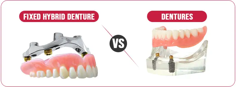 fixed hybrid denture vs dentures
