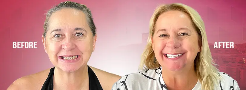 should travel mexico dental treatment