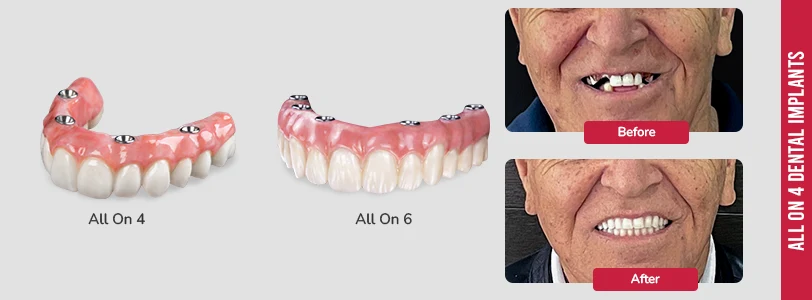 all on 4 dental implants cost vs all on x
