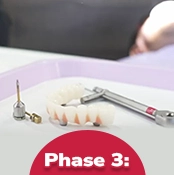 all-on-x procedure expect x dentistry tijuana phase 1