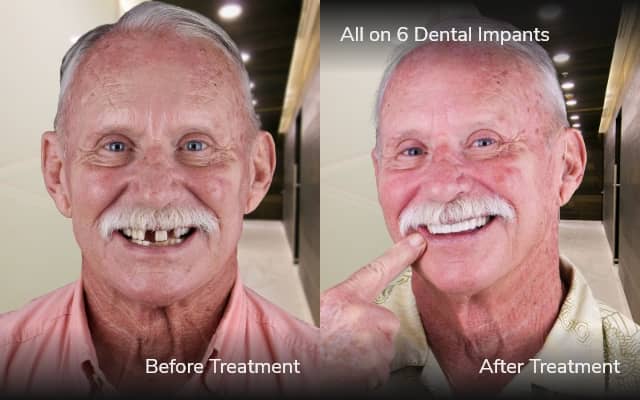 b&a all on 4 tijuana x dentistry