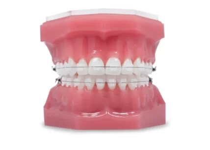 dental braces ceramic