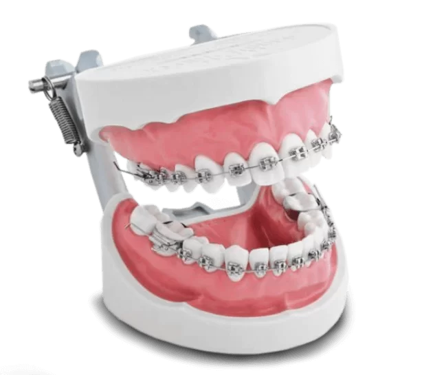 metal brace design tijuana xdentistry