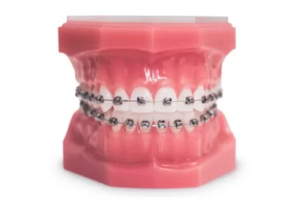 metal braces tijuana