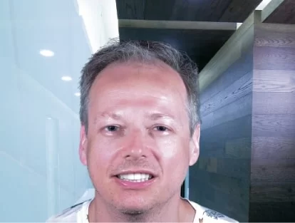 x dentistry crowns all on 4 patient