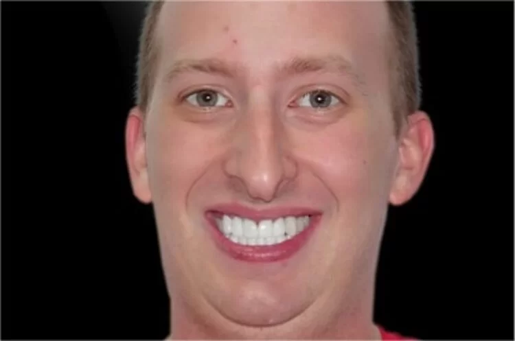 x dentistry crowns after 02