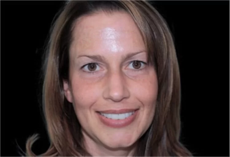 x dentistry crowns after 03