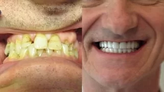 x dentistry crowns before after 02