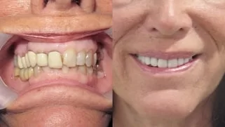 x dentistry crowns before after 03
