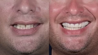 x dentistry crowns before after 07