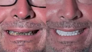 x dentistry crowns before after 10
