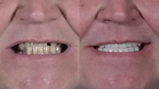 x dentistry crowns before after 11