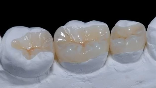 x dentistry inlays onlays model