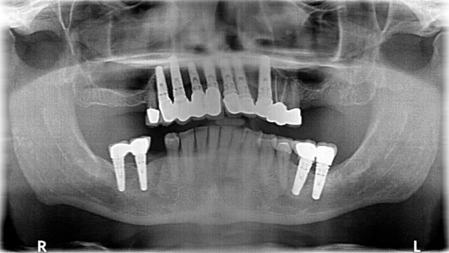 x dentistry implant panoramic x ray 01