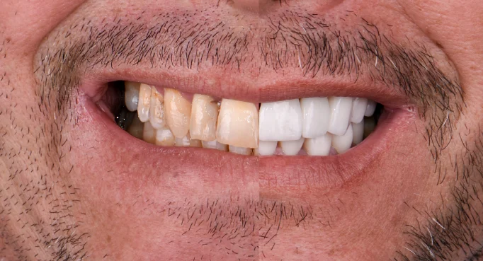 x dentistry patient before after implants 04 1