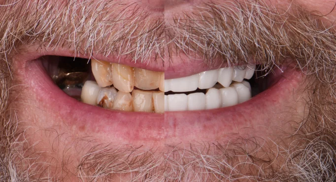 x dentistry patient before after implants 05 1