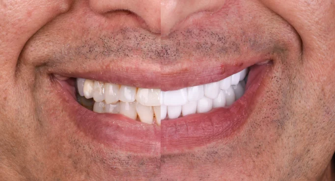 x dentistry patient before after implants 08 1