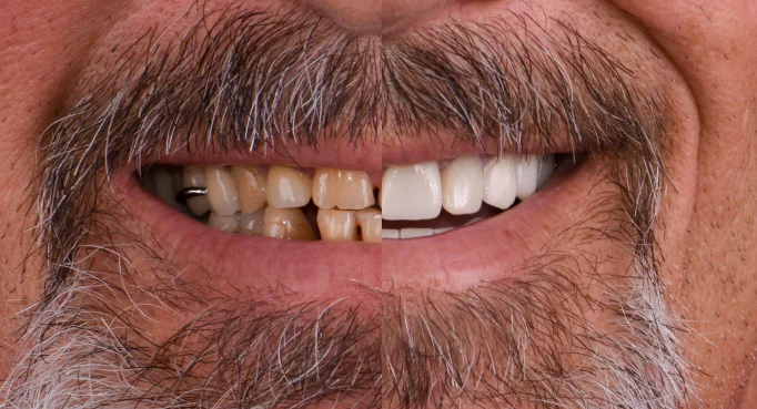 x dentistry patient before after implants 11 1
