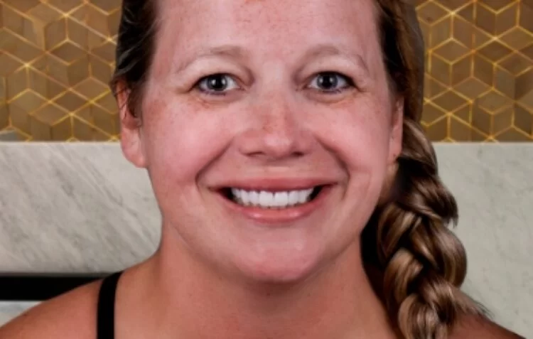 dental veneers patient after tijuana xdentistry