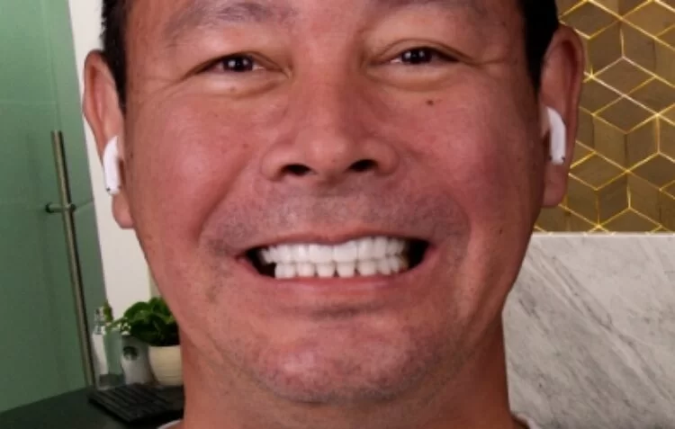 3-on-6 dental implants patient after tijuana xdentistry