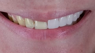 x dentistry cosmetic dentistry before after patient 02