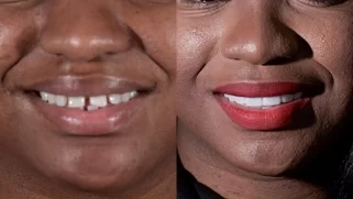 x dentistry cosmetic dentistry before after patient 03