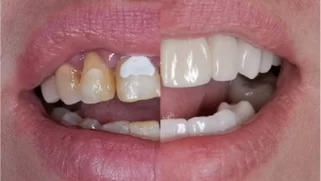 x dentistry cosmetic dentistry before after patient 10
