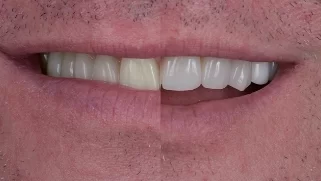 x dentistry cosmetic dentistry before after patient 11