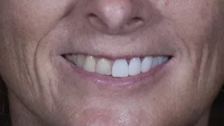 x dentistry cosmetic dentistry before after patient 12
