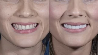 x dentistry cosmetic dentistry before after patient 13