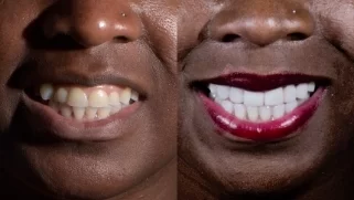 x dentistry cosmetic dentistry before after patient 14