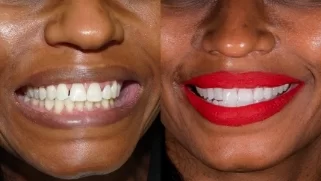 x dentistry cosmetic dentistry before after patient 15