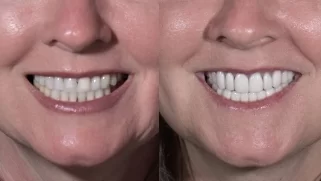 x dentistry cosmetic dentistry before after patient 16