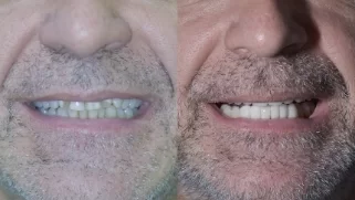 x dentistry cosmetic dentistry before after patient 09