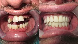 x-dentistry-restorative dentistry before after patient 01