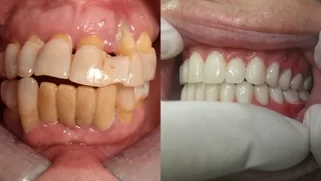 x-dentistry-restorative dentistry before after patient 02