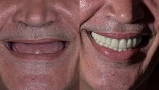 x-dentistry-restorative dentistry before after patient 07